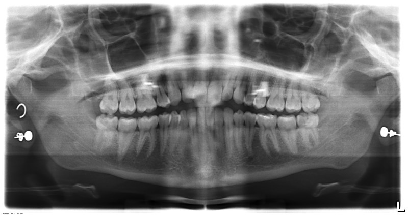 teethxray